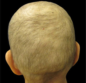 Alopecia induzida por quimioterapia. Paciente com câncer de mama no fim do tratamento com quatro ciclos de doxorrubicina e ciclofosfamida (Foto cortesia de Lívia Nicoletti Ariano).