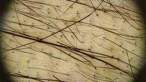 Achados tricoscópicos na região do vértice do couro cabeludo da paciente na Figura 1: múltiplos pontos pretos, pelos em círculo e pelos em regeneração. Poucos pelos terminais, alguns mostram pontos de constrição (Pohl‐Pinkus) em sua extensão, relacionados a ciclos anteriores de quimioterapia (Foto cortesia de Lívia Nicoletti Ariano).