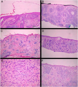 Subtipos histológicos de CBC. (A) superficial; (B) nodular; (C) micronodular; (D) infiltrativo; (E) esclerodermiforme; (F) metatípico (Hematoxilina & eosina, 40×).
