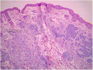 Carcinoma basocelular misto composto pelos subtipos nodular e infiltrativo (Hematoxilina & eosina, 10×).