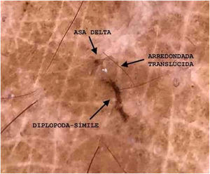 Demonstração das estruturas: (i) asa delta: porção anterior do corpo e patas dianteiras do ácaro; (ii) diplopoda‐símile: túnel escabiótico; (iii) arredondada translúcida: corpo do ácaro. (Dermatoscopia digital, 10× com imersão, sob luz polarizada, zoom óptico, 2× e amplificação da imagem).