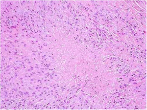 Granuloma com necrose central circundada por células epitelioides em paliçada (Hematoxilina & eosina, 100×).