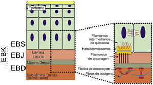 Representação das camadas da pele associadas aos diferentes tipos de epidermólise bolhosa (EB). Na epiderme, os queratinócitos estão retratados. A epiderme é anexada à derme pela membrana basal, formada pela lâmina lúcida e lâmina densa. Ao lado esquerdo da figura é apresentado cada tipo principal de EB próximo à respectiva camada da pele na qual ocorre a formação das bolhas. A clivagem na EB simples (EBS) ocorre dentro dos queratinócitos basais; na EB juncional (EBJ), dentro da lâmina lúcida; e na EB distrófica (EBD), na sublâmina densa, na porção superior da derme (derme papilar). Na EB de Kindler (EBK), a clivagem pode ocorrer nos queratinócitos basais, na lâmina lúcida ou abaixo da lâmina densa. Ao lado direito da figura são apresentados os principais complexos de adesão das camadas da pele que estão associados aos subtipos de EB. Em destaque estão representados os hemidesmossomos, os filamentos de ancoragem e as fibrilas de ancoragem, que têm papel essencial para a estável adesão dos queratinócitos basais da epiderme à zona da membrana basal e para a ligação da lâmina densa à porção superior da derme.
