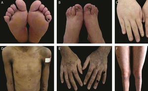 Aspectos clínicos da epidermólise bolhosa simples (EBS). (A‐C) Ceratoderma plantar, unhas distróficas e espessas em mãos e pés de pacientes com EBS localizada; (D‐F) bolhas e erosões distribuídas de maneira generalizada em pacientes com EBS intermediária. A presença de nevos da EB é comum em todos os subtipos de EBS.