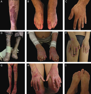 Aspectos clínicos da epidermólise bolhosa distrófica (EBD). (A) Paciente com EBD dominante pré‐tibial. (B‐C) Distrofia das unhas de pés e mãos de pacientes com EBD dominante localizada. (D‐E) Pseudosindactilia (fusão dos dedos) e distribuição generalizada de bolhas e extensas cicatrizes em paciente com EBD recessiva grave. (G‐H) Bolhas e cicatrizes generalizadas especialmente em joelhos, pernas, pés e mãos em paciente com EBD recessiva intermediária; a hiperqueratose das mãos e dos pés leva a contraturas de flexão. (F, I) Bolhas e lesões restritas a mãos e pés e distrofia de unhas em pacientes com EBD recessiva localizada.