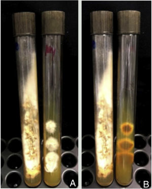 (A) Cultura em meio de Saboraud com cloranfenicol de fragmento de pele: observa‐se colônia filamentosa pulverulenta branca; (B) reverso pigmentado de coloração lilás.
