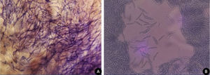 (A) Exame direto da lesão cutânea evidencia grande número de fungos filamentosos; (B) microcultivo da colônia corado pelo lactofenol azul algodão, com macroconídios com morfologia, característica do tipo canoa.