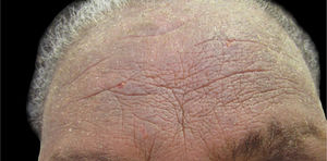 Paciente com eczema crônico (intensa liquenificação na fronte) por dermatite alérgica de contato à metilisotiazolinona presente nos xampus de que fazia uso.