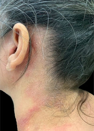 Paciente com dermatite alérgica de contato a componentes dos xampus envolvendo regiões pré‐auricular, retroauricular e cervical lateral (áreas por onde escorre o produto após o enxague).