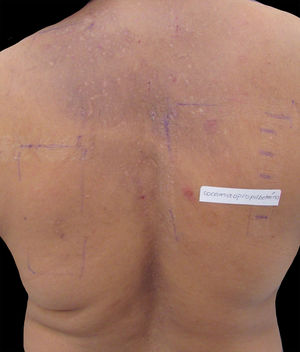 Paciente com hipercromia e escoriações no dorso causadas pelo prurido da dermatite alérgica de contato à cocoamidopropilbetaína dos xampus (com teste de contato evidenciado).