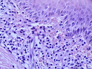 Infiltrado linfo‐histiocitário na derme superior, assim como extravasamento de hemácias. Possível ver focos de exocitose de linfócitos (Hematoxilina & eosina, 400×).