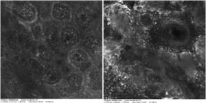 Ninhos regulares bem delimitados na junção dermoepidérmica e infiltração pagetoide. (VivaScope1500, A e B, imagens básicas 0,5 × 0,5mm).
