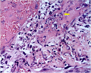 Fusariose. Histopatologia de lesão cutânea (Hematoxilina & eosina, 40×). Vasos com necrose da parede fibrinoide e trombose oclusiva em seus lúmens, acompanhados por um infiltrado inflamatório perivascular superficial composto por linfócitos, neutrófilos e leucocitoclasia. A seta amarela destaca a presença de estruturas filamentosas intravasculares, correspondentes às hifas septadas.