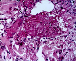 Fusariose. Histopatologia de lesão cutânea (PAS, 40×). Hifas septadas e conidióforos intravasculares são evidentes.