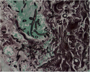 Fusariose. Histopatologia de lesão cutânea (Grocott‐Gomori, 40×). Hifas septadas e conidióforos intravasculares são evidentes.