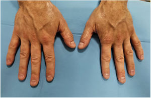 Manchas simétricas de vitiligo na face dorsomedial das mãos.