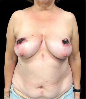 O exame físico revelou placas erosadas bilaterais, simétricas, bem delimitadas, em ambas as mamas.