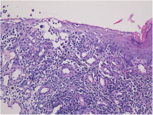 O exame histológico evidenciou muitas células atípicas que se infiltravam irregularmente da epiderme à derme (Hematoxilina & eosina, 200×).