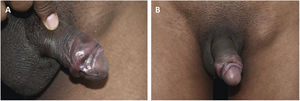 (A) Sífilis recente. Lesão em cordão (VDRL 1:128). (B) Observar volumosa adenomegalia indolor.