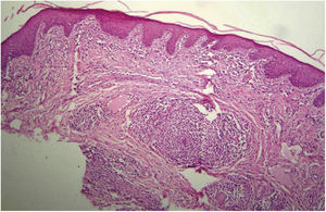 Hiperceratose e acantose regular do epitélio. No córion, infiltrado linfoplasmocitário em torno de vasos superficiais (Hematoxilina & eosina,100×).