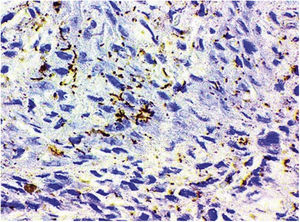 Imuno‐histoquímica−Paciente n° 1. Positividade para Treponema pallidum.