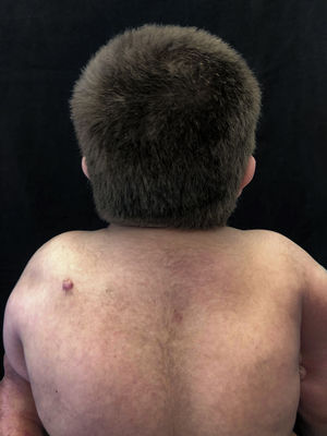 Lesão nodular eritematosa em região escapular esquerda excisada. Hipertricose leve sobre coluna dorsal e ombros.