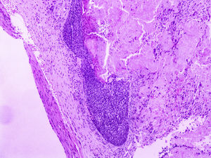 Aspecto anatomopatológico: proliferação nodular composta por células basaloides matriciais e células fantasma (Hematoxilina & eosina, 10×).