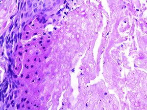 Aspecto anatomopatológico: proliferação nodular composta por células basaloides matriciais e células fantasma (Hematoxilina & eosina, 40×).
