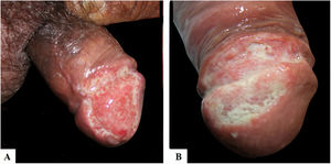 Presença de ulceração indolor na glande e sulco balanoprepucial dos pacientes número dois (A) e quatro (B).
