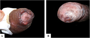 (A) Paciente número três com múltiplas úlceras dolorosas distribuídas no prepúcio e corpo do pênis; (B) presença de cicatrizes hipercrômicas na glande após tratamento.