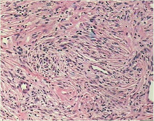 Histopatologia: proliferação fusocelular com padrão focalmente estoriforme. (Hematoxilina & eosina 100x).