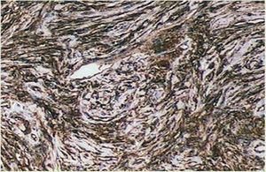 Imuno‐histoquímica: positividade difusa para CD34 nas células fusiformes de padrão estoriforme.