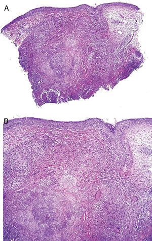 A, Epiderme sem alterações relevantes. Processo granulomatoso ocupa derme média e profunda. Área de necrose caseosa no centro do processo granulomatoso (Hematoxilina & eosina, 40×). B, Necrose focal e reação granulomatosa com células gigantes (Hematoxilina & eosina, 100×). Pesquisa negativa para bacilos álcool‐ácido resistentes (BAAR) e fungos.