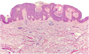 Histopatologia de uma das lesões da mama evidencia proliferação de células basaloides, uniformes, alongamento dos cones interpapilares e hiperceratose. Observam‐se, ainda, pseudocistos de queratina e hiperpigmentação melânica da epiderme (Hematoxilina & eosina, 10×).