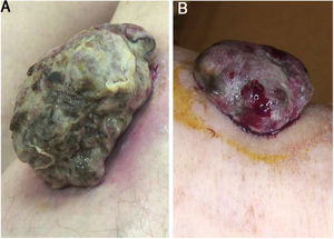 (A), Massa nodular séssil, 1,8×4,5cm em sua maior dimensão, circundada por halo eritematoso na região anterior da perna. Podem ser observadas áreas necróticas e fibrinosas e filamentos de gaze incorporados à superfície tumoral. (B), Nódulo séssil de base ampla (1,5×3,8cm em sua maior dimensão) na região anterior da perna, deformando a pele subjacente. Áreas necróticas e fibrinosas e sangramento são evidentes.