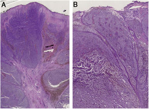 (A), Histopatologia evidencia traves fibroepiteliais que subdividem o tumor em lóbulos. A distribuição do pigmento é irregular, tanto em quantidade quanto em profundidade. Vasos pleomórficos e ulceração são visíveis ao longo das lesões. (B), Os achados histopatológicos incluem ulceração, vasos pleomórficos atípicos com depósitos esparsos de pigmento e ausência de cones epidérmicos. O infiltrado inflamatório é escasso.