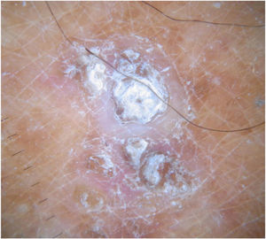 O exame dermatoscópico evidenciou um tampão ceratótico central circundado por uma área sem estrutura branca com escamas e área vermelho‐pálida sem estrutura e sem vasos nítidos.