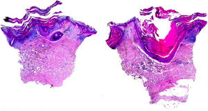 Abertura folicular cisticamente dilatada preenchida com queratina, leve acantose da epiderme e hiperceratose com orto e paraqueratose. A parede epitelial e a epiderme apresentavam hiperceratose epidermolítica (Hematoxilina & eosina, 20×).