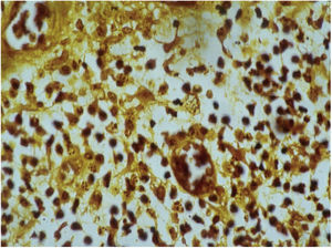Histopatologia revela presença de corpúsculos de Donovan. Coloração de Warthin‐Starry. Cortesia: Professor Luis Carlos de Lima Ferreira.