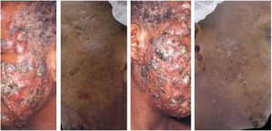 Paciente de 22 anos com acne conglobata apenas na face havia 15 meses. Tratado anteriormente com antibióticos orais e produtos tópicos (não soube informar nomes), sem melhora. Foi introduzida isotretinoína 20 mg/dia (0,3 mg/kg/dia) e prednisona 40, 30, 20 e 10 mg/dia a cada sete dias. A duração do tratamento, sempre com a mesma dose diária, foi de 18 meses (160 mg/kg), até resolução completa das lesões. Tratamento de manutenção com peróxido de benzoíla 5% por 12 meses. Não houve recidiva.