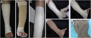(A), Bota de Unna; (B), Sistema de velcro; (C), Faixa elástica (camada única); (D−F), Compressão multicamadas; (G), Meia elástica de alta compressão com zíper.