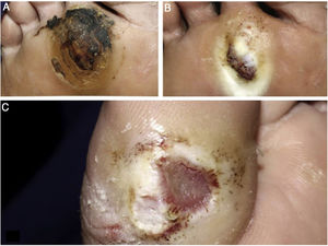 (A), Hiperceratose e crostas hemáticas no antepé; (B), Após limpeza, úlcera de fundo granuloso e hiperceratósica; (C), Úlcera com bordas calosas no hálux.