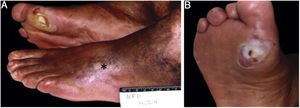 Paciente diabético. (A), Cicatriz de úlcera arterial (*) no pé esquerdo e úlcera neuropática no primeiro metatarsiano direito; (B), Calosidade periférica desbastada.