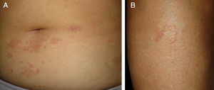 Lesões violáceas‐eritematosas anulares no abdômen e extremidades inferiores.