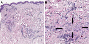 (A), Amostra de pele com focos de inflamação crônica intersticial na derme reticular (Hematoxilina & eosina, 20×). (B), Em um aumento maior, observa‐se uma evidente necrobiose das fibras de colágeno (setas pretas), associada a infiltrado linfo‐histiocitário (Hematoxilina & eosina, 40×).