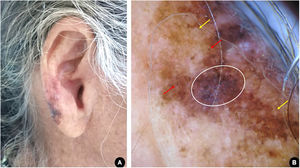 (A), Mancha pigmentada assimétrica, multicolorida e de contornos irregulares no lóbulo auricular direito. (B), Dermatoscopia sugestiva de melanoma lentigo maligno: área cinza‐azulada homogênea com estruturas romboidais (círculo branco); pigmentação das aberturas foliculares (setas vermelhas); círculo dentro de um círculo (setas amarelas).
