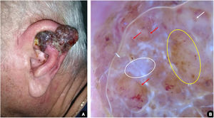 (A), Tumoração exofítica eritemato‐violácea acometendo hélice da orelha esquerda, com presença de pápulas satélites confluentes. (B), Dermatoscopia sugestiva de melanoma nodular: véu branco‐azulado (círculo branco); padrão vascular atípico, com vasos lineares irregulares (setas vermelhas) e glóbulos vermelhos leitosos (seta branca); pontos e glóbulos irregulares de distribuição assimétrica (círculo amarelo).