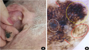 (A), Mácula enegrecida, assimétrica, no lóbulo auricular direito. (B), Dermatoscopia sugestiva de melanoma de disseminação superficial: véu branco‐azulado (círculo branco), área homogênea com folículos pilosos obliterados e estrias irregulares (círculo amarelo); estruturas romboidais (seta vermelha); círculo dentro de círculo (círculo vermelho).
