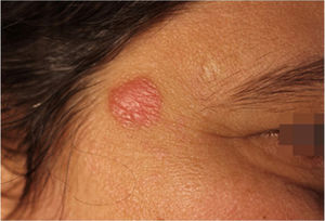 Placa eritematosa, circular, de bordas nítidas e superfície lisa, de cerca de 1,2cm de diâmetro em região temporal direita.
