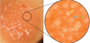 Dermatoscopia de contato com luz polarizada, sem imersão, com grupamentos de rosetas de cerca de 0,2mm, orientadas no mesmo sentido, entremeadas por white dots. No detalhe, nota‐se uma roseta bem formada (seta amarela), um esboço de roseta (seta azul) e um white dot (seta verde).